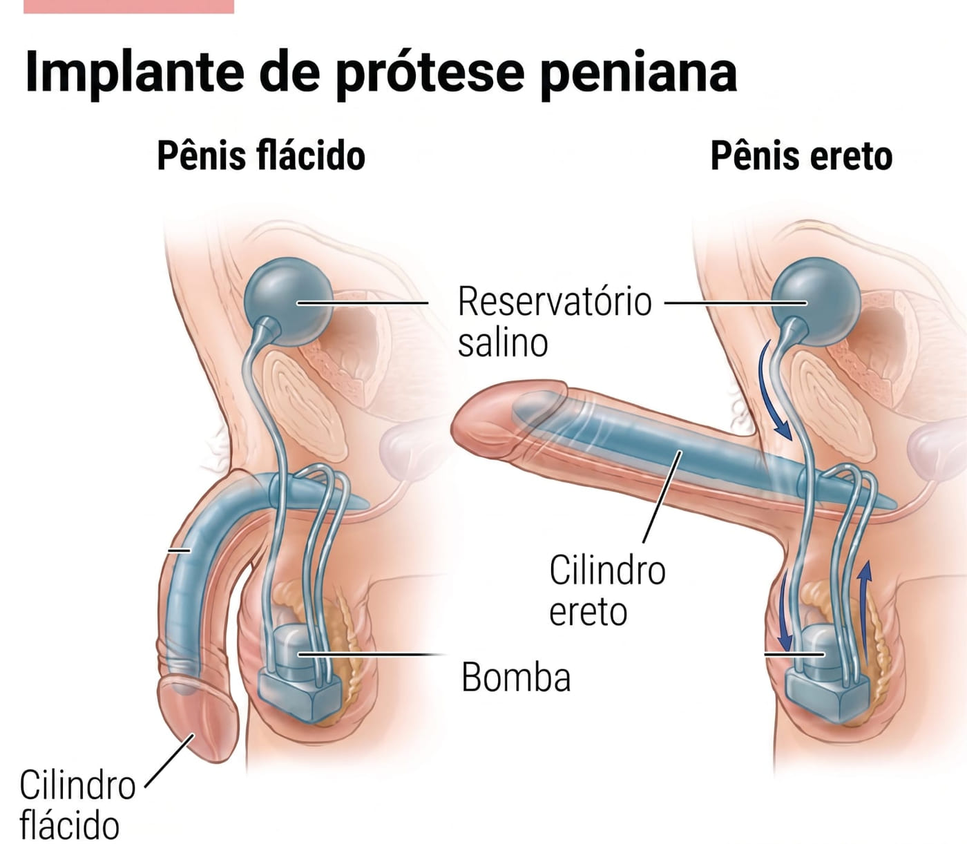 Esquema do implante de prótese peniana inflável, com o pênis flácido e ereto, indicando reservatório salino, cilindro e bomba
